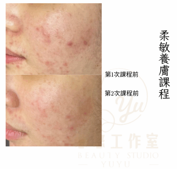 員林做臉推薦,修護敏感泛紅