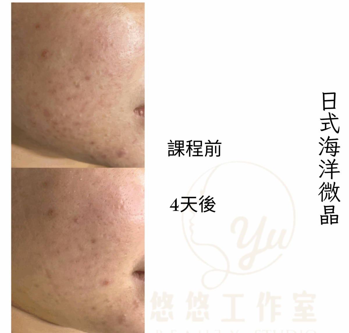 員林做臉推薦，日式微晶，頂級藻針